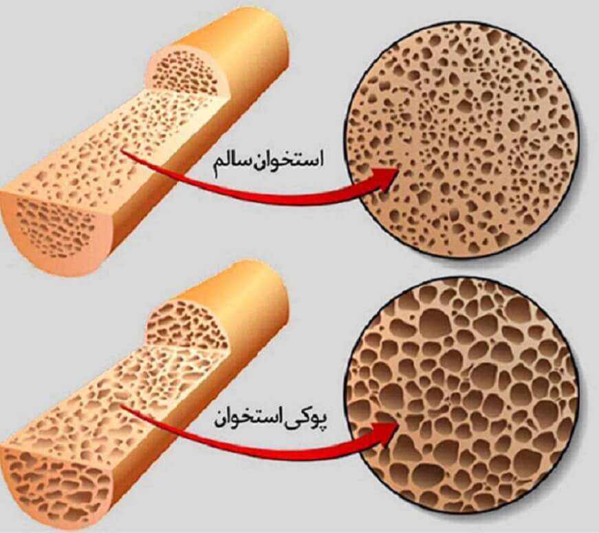 درمان پوکی اسخوان با مصرف انجیرخشک