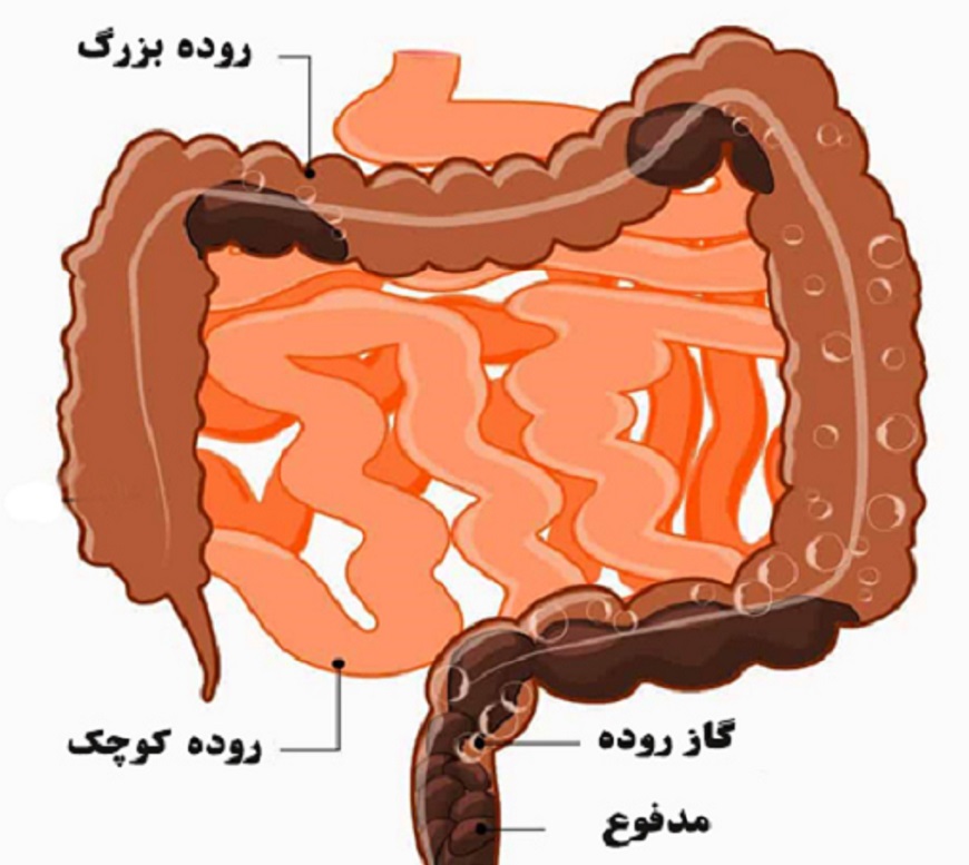 درمان یبوست
